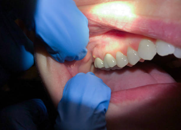 Best Emergency Gum Treatment in Laurel, VA