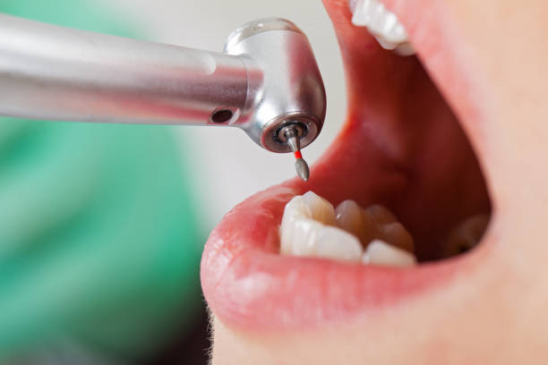 Best Urgent Care for Lost Fillings or Crowns in Laurel, VA